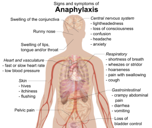 Diagram-Anaphylaxis-symptoms
